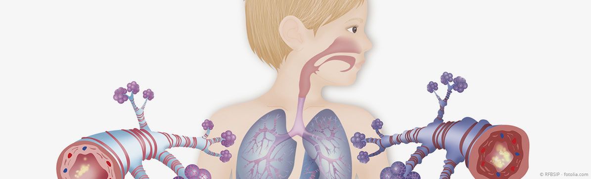 FORSCHUNG AM CPC-M - chILD – seltene Lungenkrankheiten, die Kindern den Atem nehmen